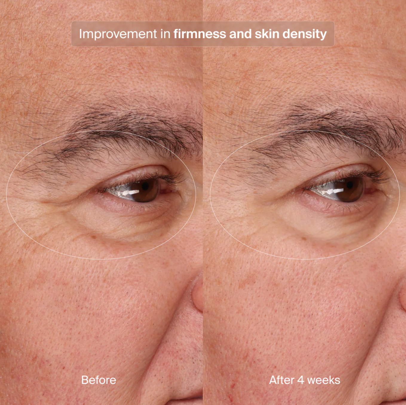 Precision Eye Lift