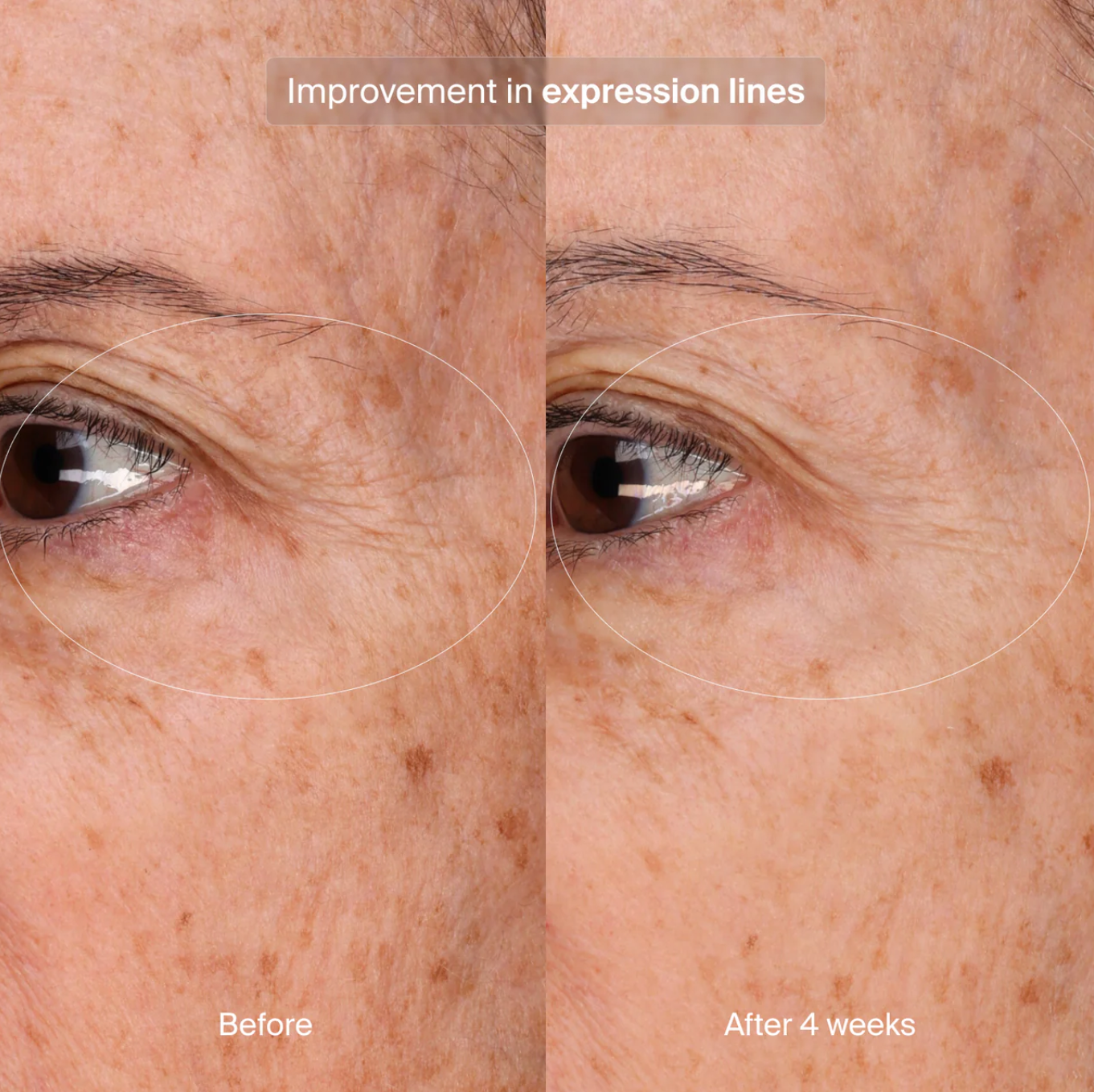Precision Eye Lift