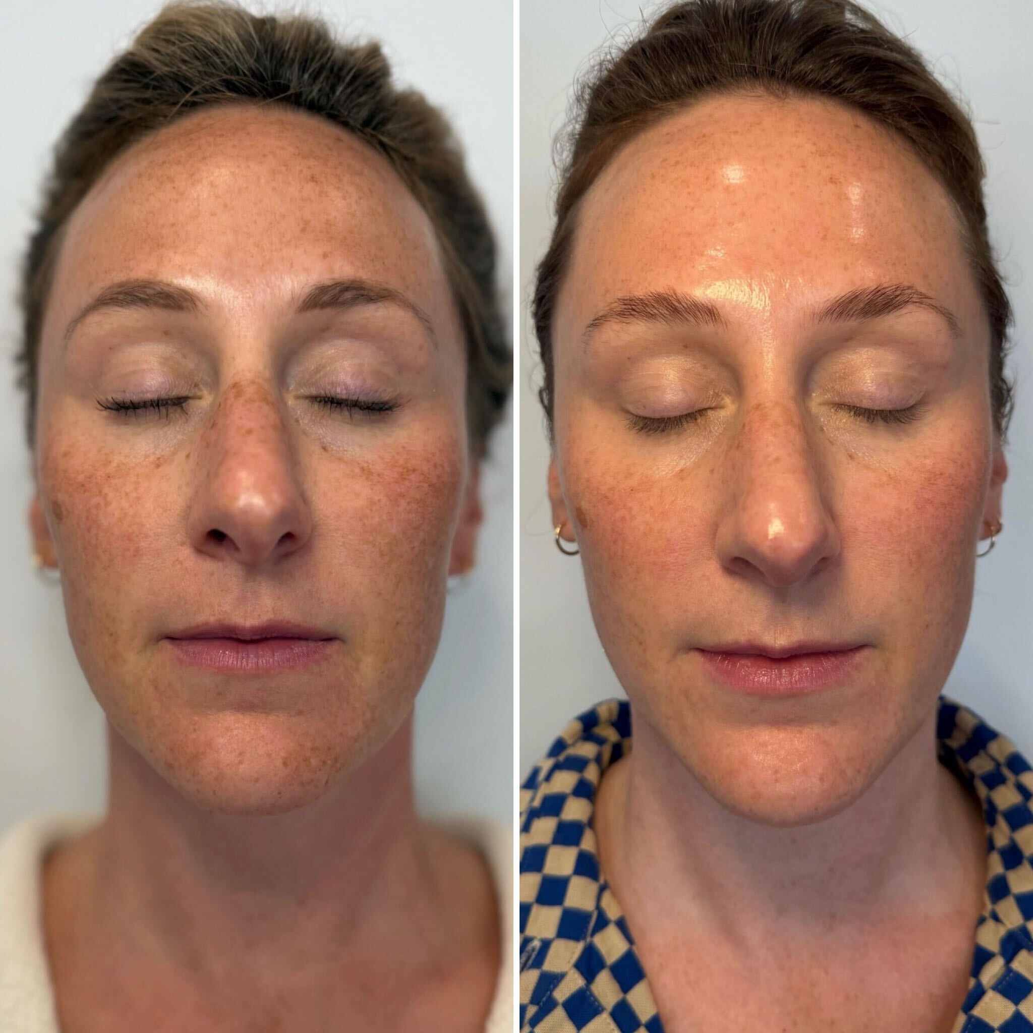 Hyperpigmentation_Elle.jpg