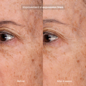 Precision Eye Lift